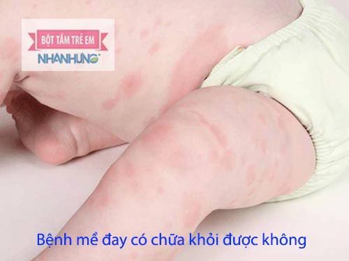 Mề đay gây nhiều phiền toái cho trẻ