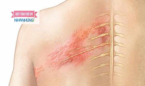 Bệnh zona thần kinh do virus Vacirella zoster gây nên