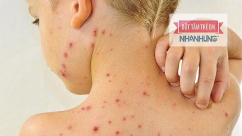 Ngứa là “đặc sản” của bệnh thủy đậu