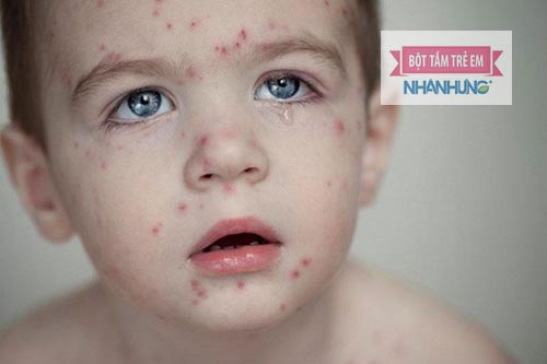 Bị thủy đậu rồi sẽ không có nguy cơ mắc lại lần 2