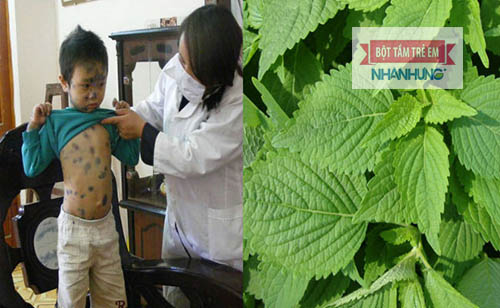 Tắm nước Lá kinh giới giúp chống viêm, kháng khuẩn, làm khô nhanh nốt mụn thủy đậu