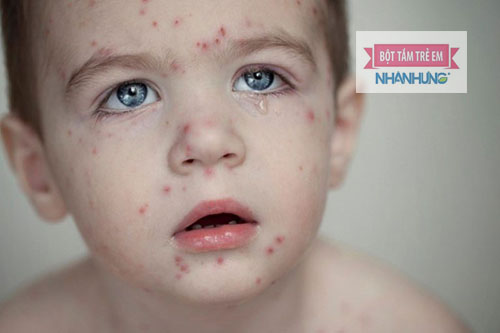 Bị thủy đậu tắm lá gì là thắc mắc của nhiều người
