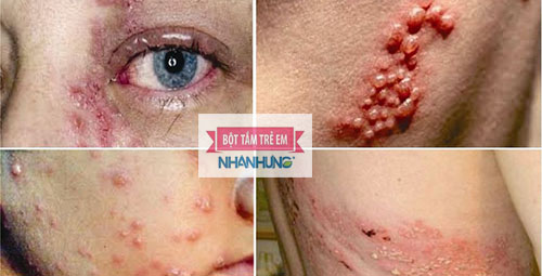 Zona thần kinh có thể gây nên những biến chứng nguy hiểm