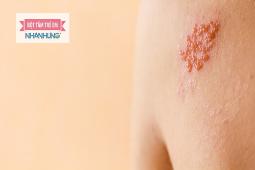 Triệu chứng nhận biết bệnh zona thần kinh