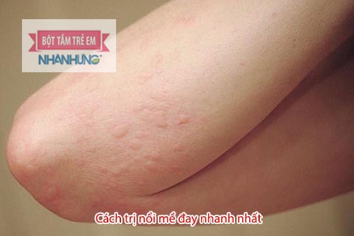 Mề đay có thể phát triển thành bệnh mạn tính, rất khó điều trị