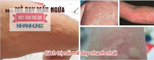 Mề đay gây ngứa ngáy, khó chịu