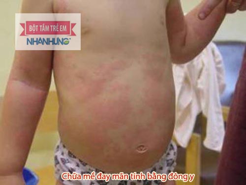 Có nhiều nguyên nhân khiến trẻ bị mề đay