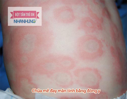 Mề đay mãn tính gây nhiều khó chịu cho trẻ