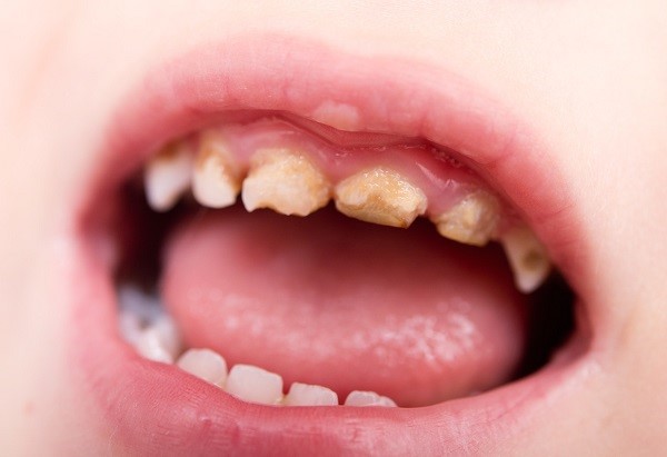 Răng sữa của bé bị mủn do vi khuẩn.