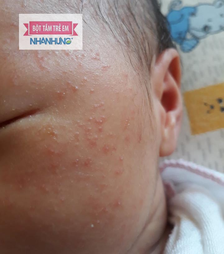 Rôm sảy có thể gây ngứa ngáy, viêm nhiễm da khiến bé vô cùng khó chịu