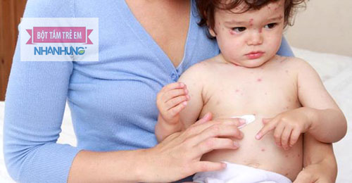 Chăm sóc trẻ bị thủy đậu ảnh hưởng lớn tới quá trình điều trị