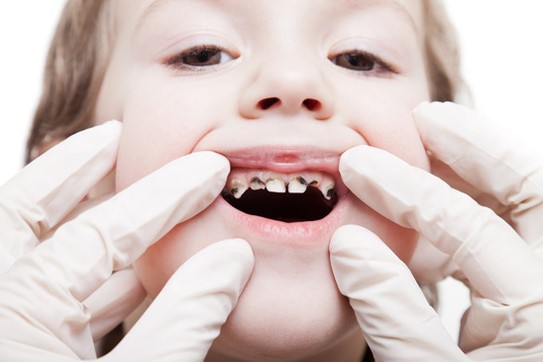 Răng sữa bị sâu chủ yếu do vệ sinh răng miệng không tốt.