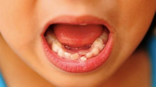 Răng sữa chưa rụng răng vĩnh viễn đã mọc là sự bất thường khi thay răng.