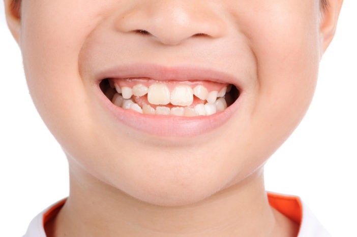 Răng sữa chưa rụng răng mới đã mọc thì cần cho bé nhổ răng càng sớm càng tốt.