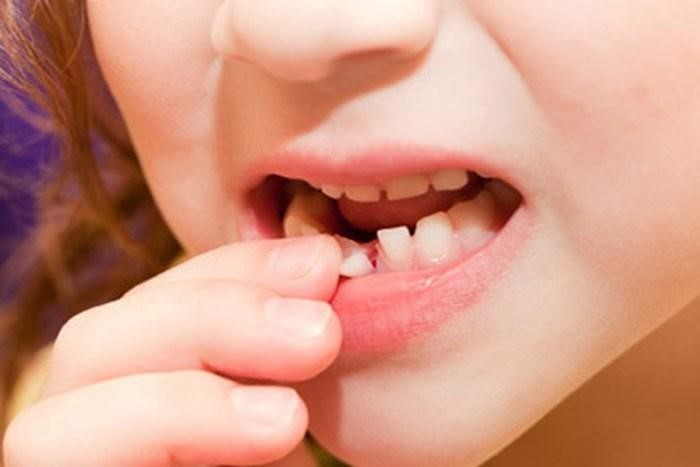 Răng sữa là răng mọc trong giai đoạn bé bú mẹ.