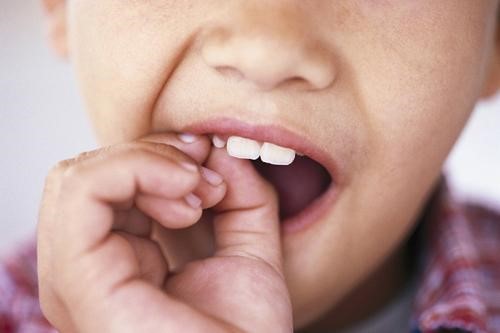 Chỉ nhổ răng sữa khi đã lung lay nhiều - răng sữa lung lay bao lâu thì nhổ được