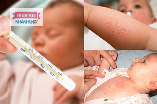 Sốt phát ban ở trẻ do virus gây nên