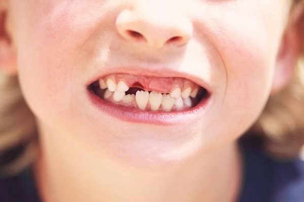 Răng sữa không rụng thì nên cho bé đi khám để ghép răng.