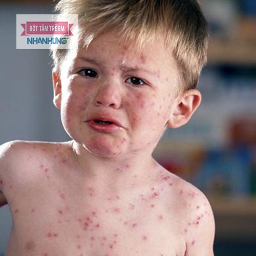 Giai đoạn toàn phát người bệnh bắt đầu nổi mụn nước