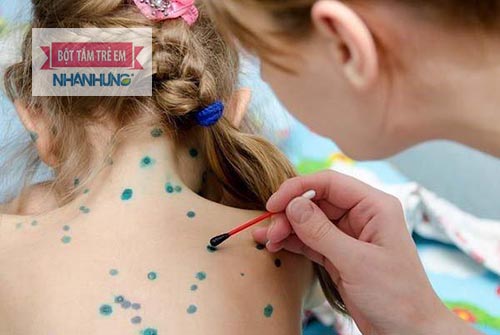 Xanh Methylen điều trị nhiễm khuẩn, hạn chế viêm nhiễm - Thuốc bôi thủy đậu không để lại sẹo