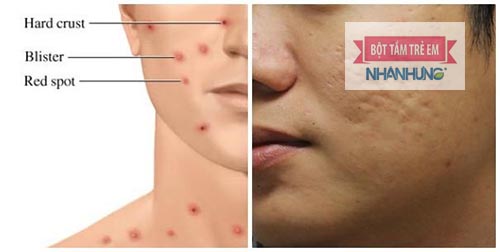 Thủy đậu để lại sẹo do da bị viêm nhiễm, lở loét - Thuốc bôi thủy đậu không để lại sẹo