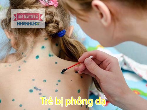 Vệ sinh da bé hàng ngày bằng Bột tắm trẻ em Nhân Hưng hoặc bôi xanh methylen 1%