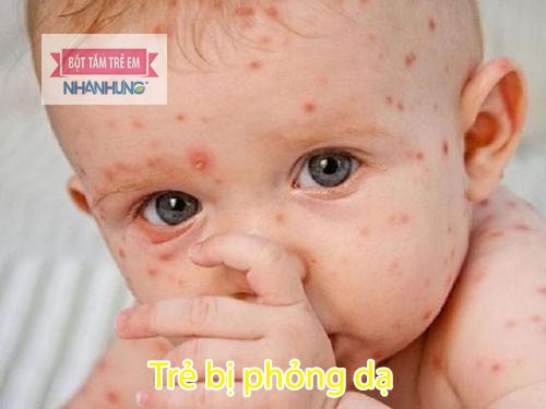 Bệnh phỏng dạ ở trẻ do virus Varicella Zoster gây nên