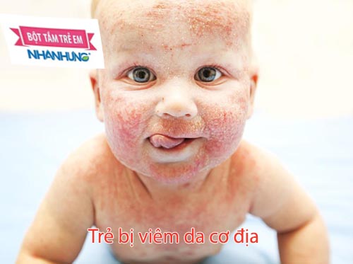 Viêm da cơ địa có thể lan khắp cơ thể trẻ