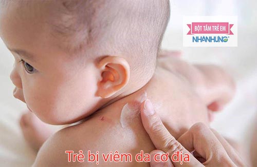 Trẻ cần sử dụng thêm thuốc bôi, thuốc uống khi bị viêm da cơ địa