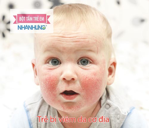 Viêm da cơ địa gặp nhiều ở trẻ dưới 2 tuổi