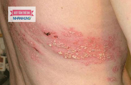 Viêm da tiếp xúc có để lại sẹo không?