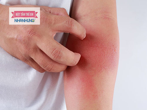 Gãi là nguyên nhân khiến vùng da bị bệnh lan rộng hơn
