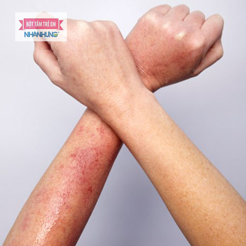 Viêm da tiếp xúc gồm hai loại: kích ứng và dị ứng