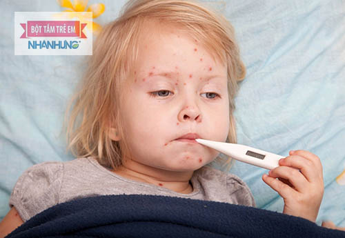 Trẻ có thể kèm theo sốt khi bị phỏng dạ