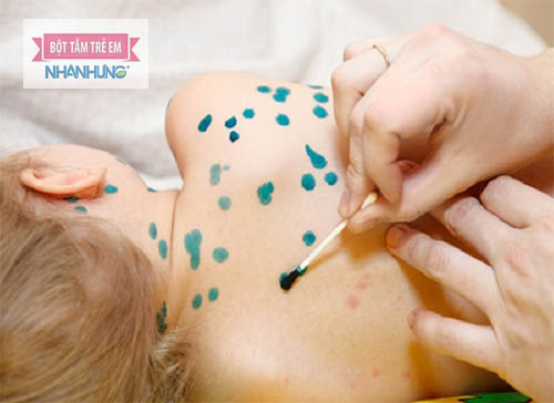 Trẻ bị phỏng dạ có thể bôi xanh Methylen