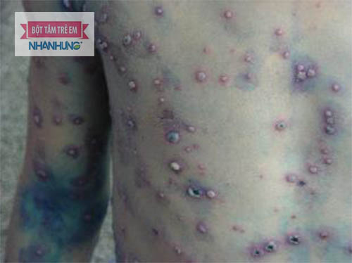 Tuyệt đối không cào, gãi, nặn các nốt phỏng dạ ở trẻ
