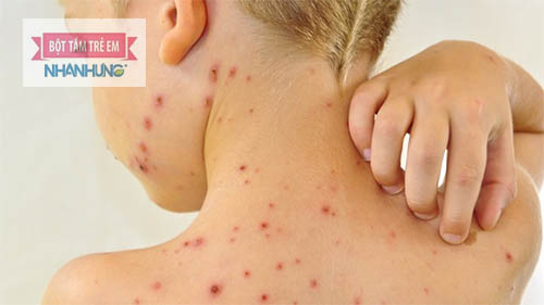 Trẻ bị phỏng dạ cần có chế độ chăm sóc hợp lý