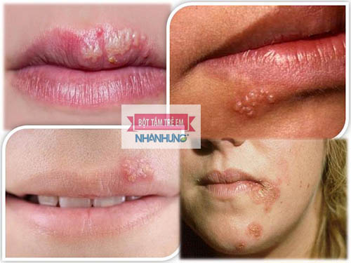Zona thần kinh có thể xuất hiện ở cả mặt, mắt, miệng