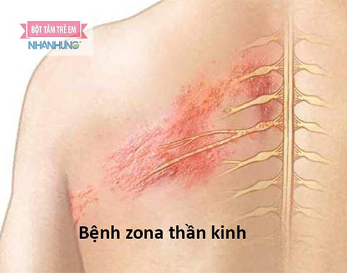 Zona lan theo dây thần kinh