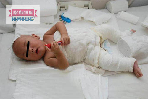 Trẻ bị bỏng cần lưu ý về chế độ dinh dưỡng