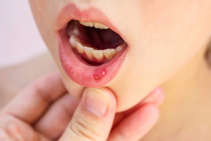 Chảy máu chân răng thường đi kèm với nhiệt miệng.