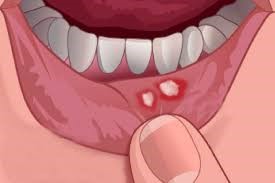 Trẻ bị nhiệt miệng thường xuất hiện các vết loét trong miệng.