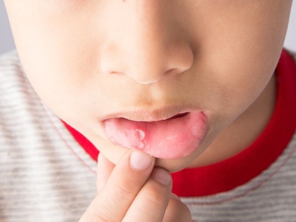 Nhiệt miệng ở trẻ em chủ yếu do virut và vi khuẩn gây ra.