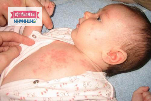 Trẻ bị mề đay mãn tính có thể dẫn đến biến chứng khó thở, sốc phản vệ.