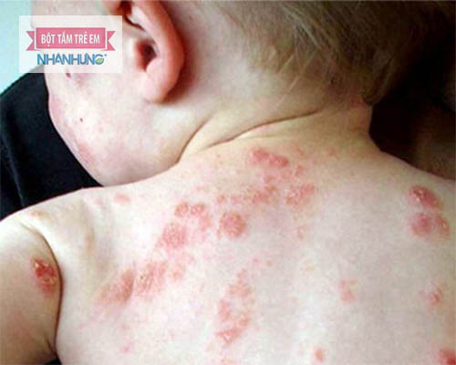Rất nhiều trẻ bị giời leo - Giời leo có lây không