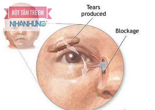 Bọng nước mắt chèn ép các ống dẫn bên trong của mắt khiến nước mắt không thoát ra ngoài