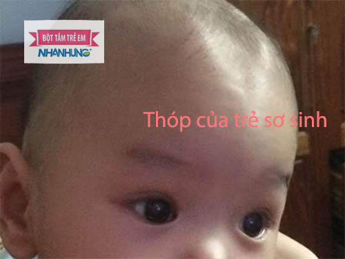 Bé bị Thóp lõm