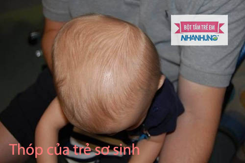 Thóp quá lớn
