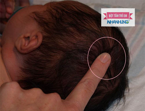Chế độ dinh dưỡng kém cũng làm thóp sau của bé lâu đóng và lõm