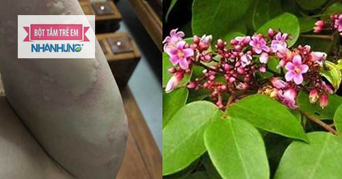 Cách chữa bệnh mề đay dân gian từ lá khế